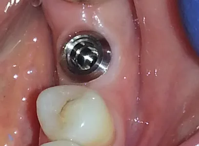 A close up of the inside of a tooth implant