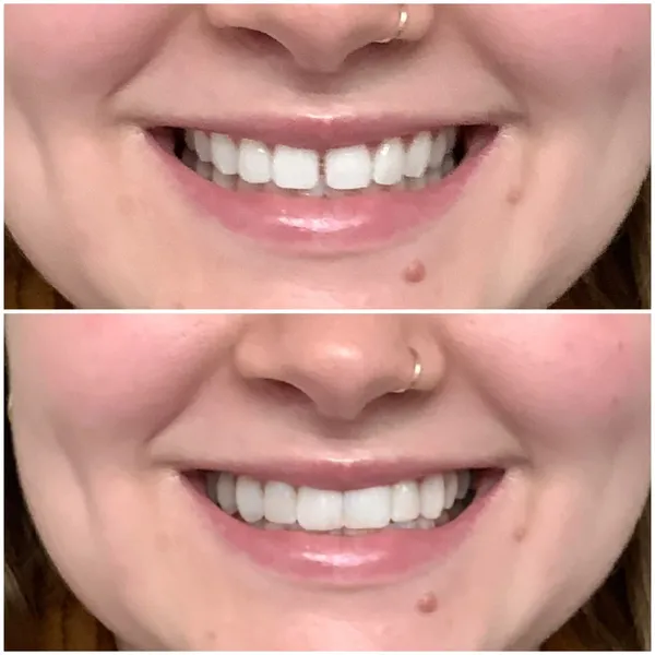 A woman with white teeth and one without.
