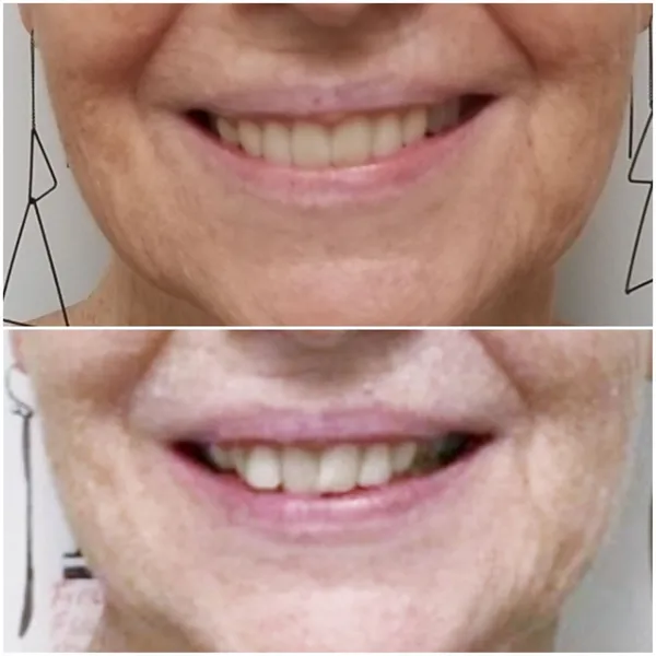 A woman with white teeth and no smile shows before and after photos of her smile.